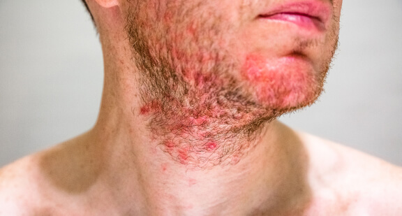 Folliculitis_ Understanding a Skin Issue Thumbnail