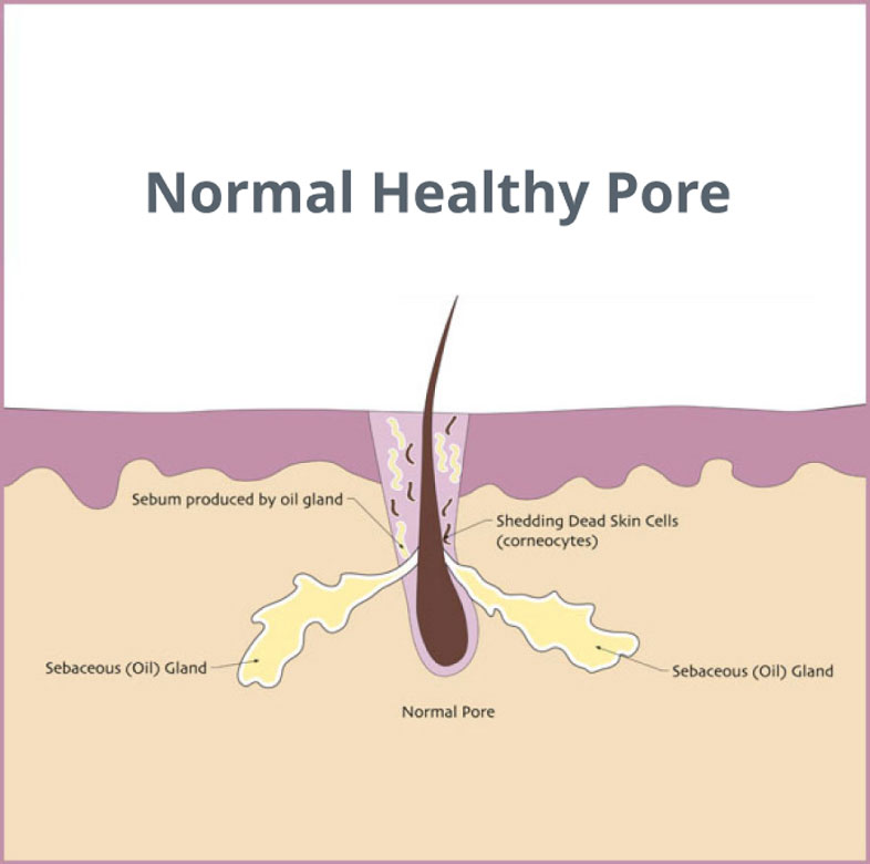 Comprehensive Guide to Acne 101 Texas | Hill Country Acne Center