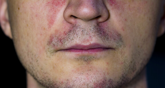 Understanding Perioral Dermatitis_ A Clear Overview Thumbnail