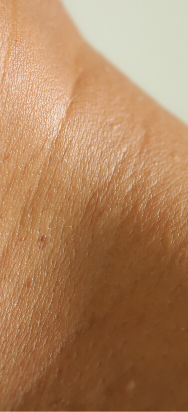 Skin Tag Treatment in Marble Falls, TX | Hill Country Acne Center